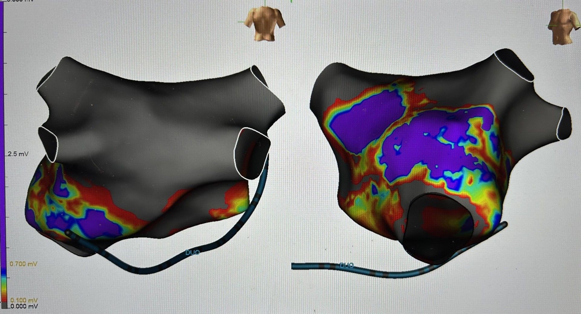 Stage 2: Catheter Ablation and Mapping